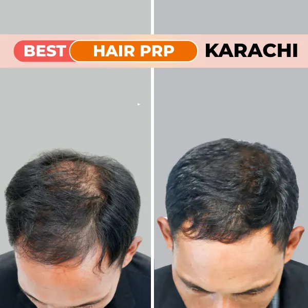 hair prp treatment