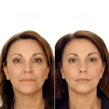 botox injections before after