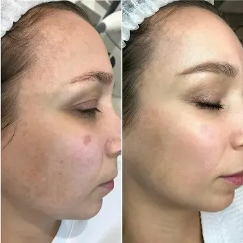 face prp treatment