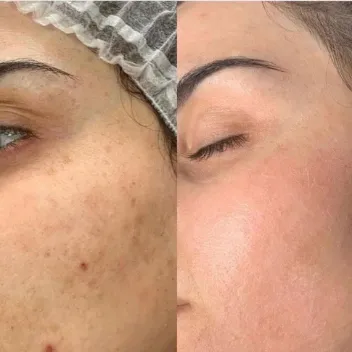face prp treatment before after