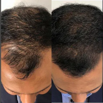 hair prp treatment