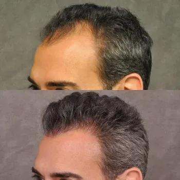 Hair PRP Treatment